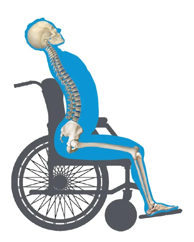 Anterior pelvic tilt wheelchair seating view