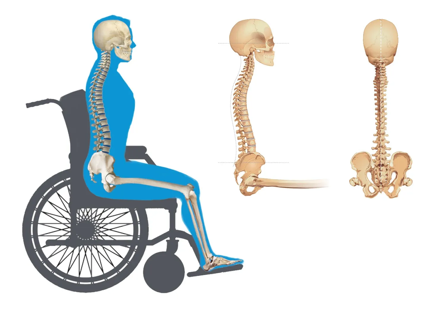 Neutral pelvic posture in wheelchair seating assessment