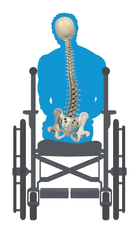 Pelvic obliquity wheelchair seating view