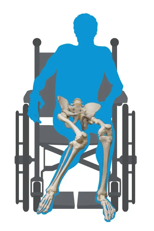 Windswept posture wheelchair seating view